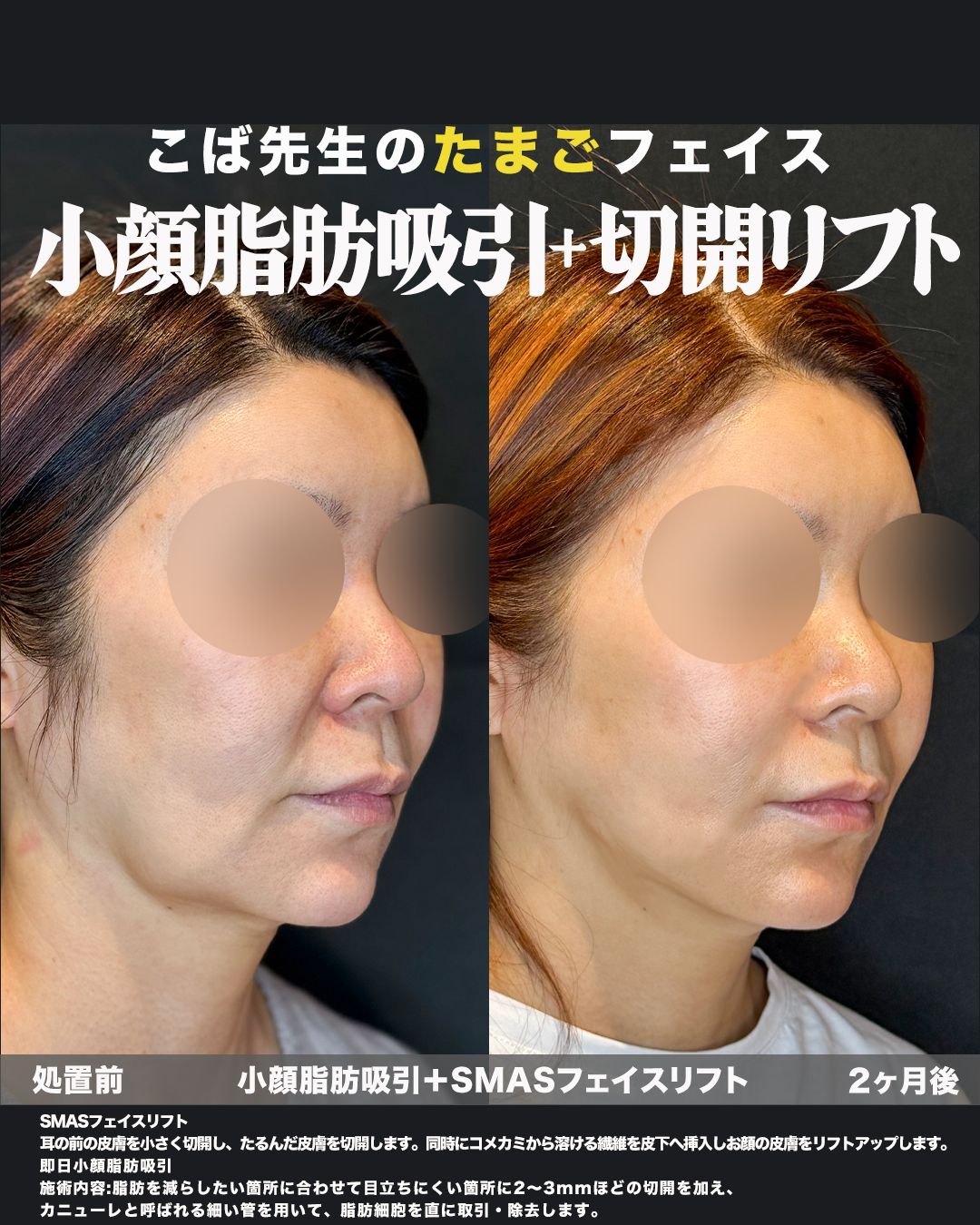 SMASフェイスリフト＋小顔脂肪吸引の症例。処置前と術後を斜めから並べた比較写真。