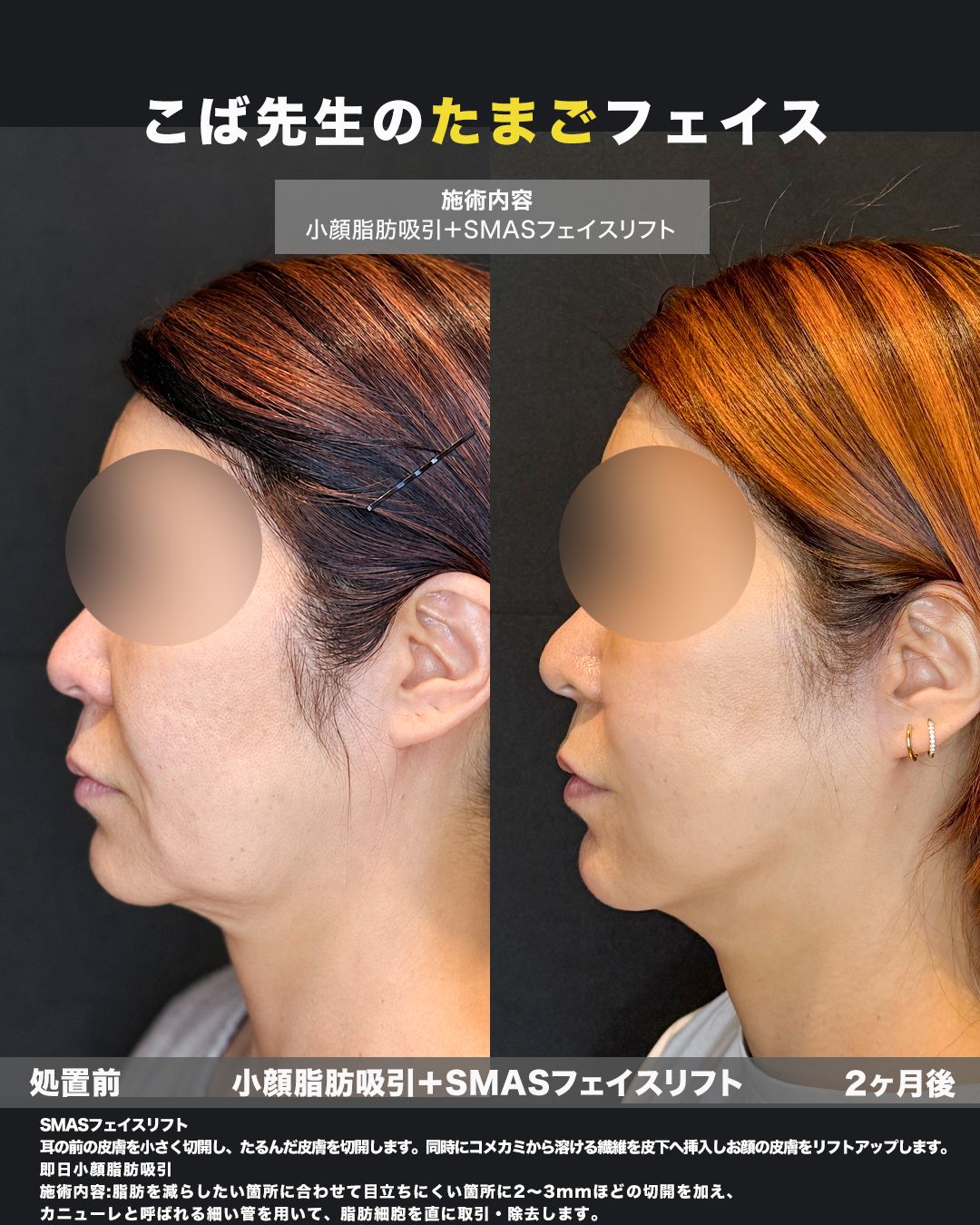 SMASフェイスリフト＋小顔脂肪吸引の症例。処置前と術後を横（側面）から並べた比較写真。