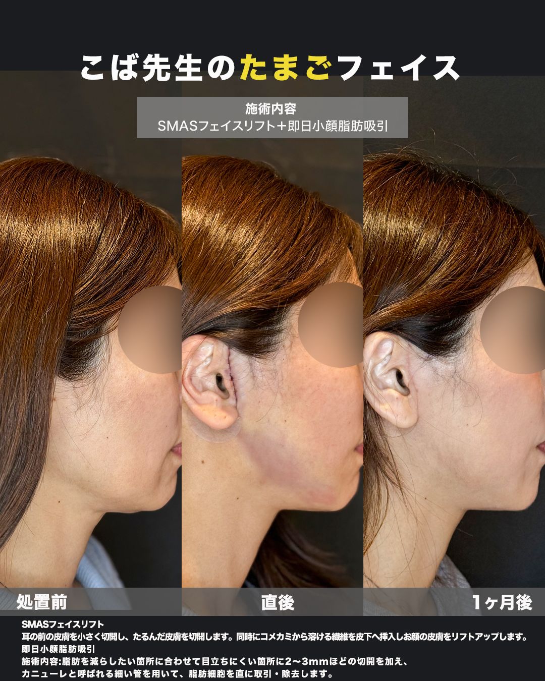 SMASフェイスリフト＋脂肪吸引の症例。処置前から術後までの経過を並べた比較写真。