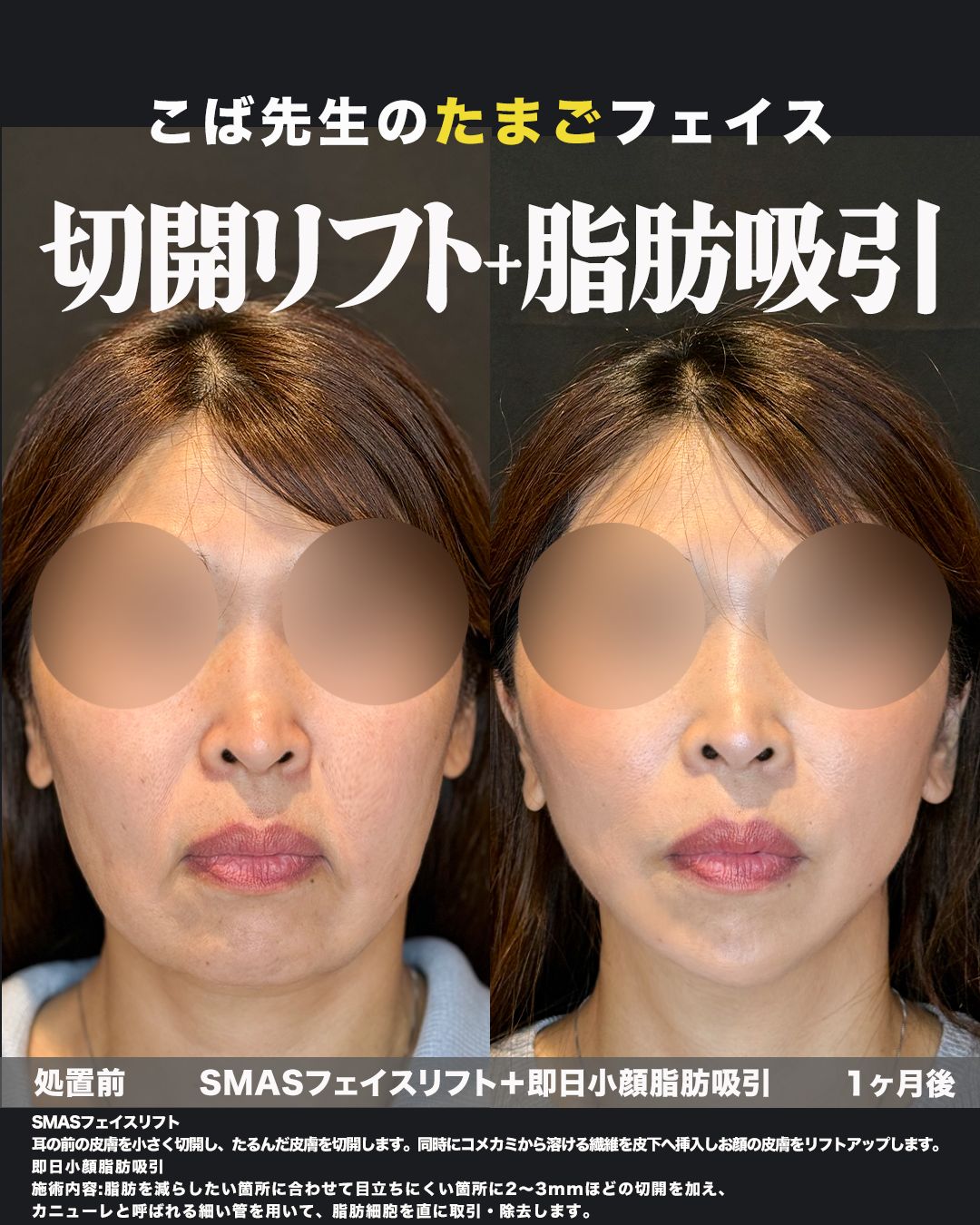 SMASフェイスリフト＋脂肪吸引の症例。処置前と術後を正面から並べた比較写真