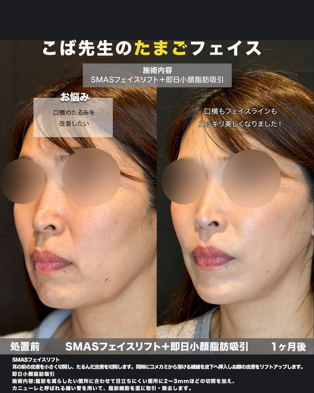 SMASフェイスリフト＋脂肪吸引の症例。処置前と術後を斜めから並べた比較写真。