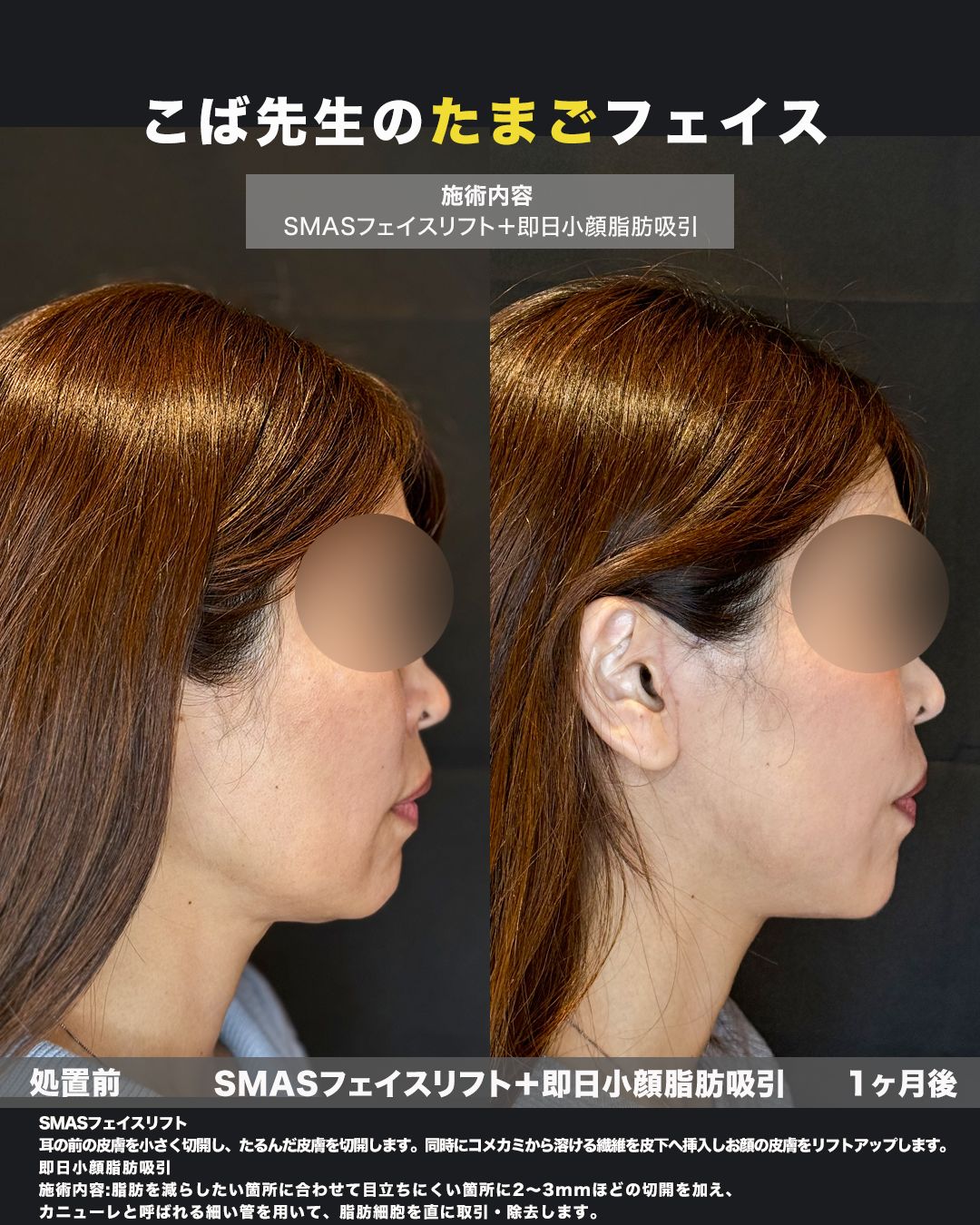 SMASフェイスリフト＋脂肪吸引の症例。処置前と術後を横（側面）から並べた比較写真。