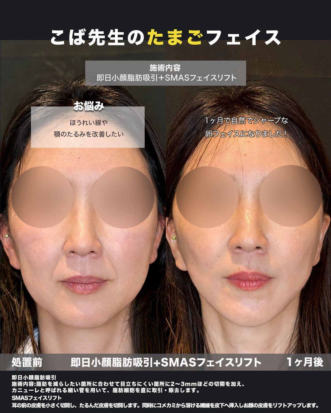 SMASフェイスリフト＋即日小顔脂肪吸引の症例。処置前と術後を正面から並べた比較写真。