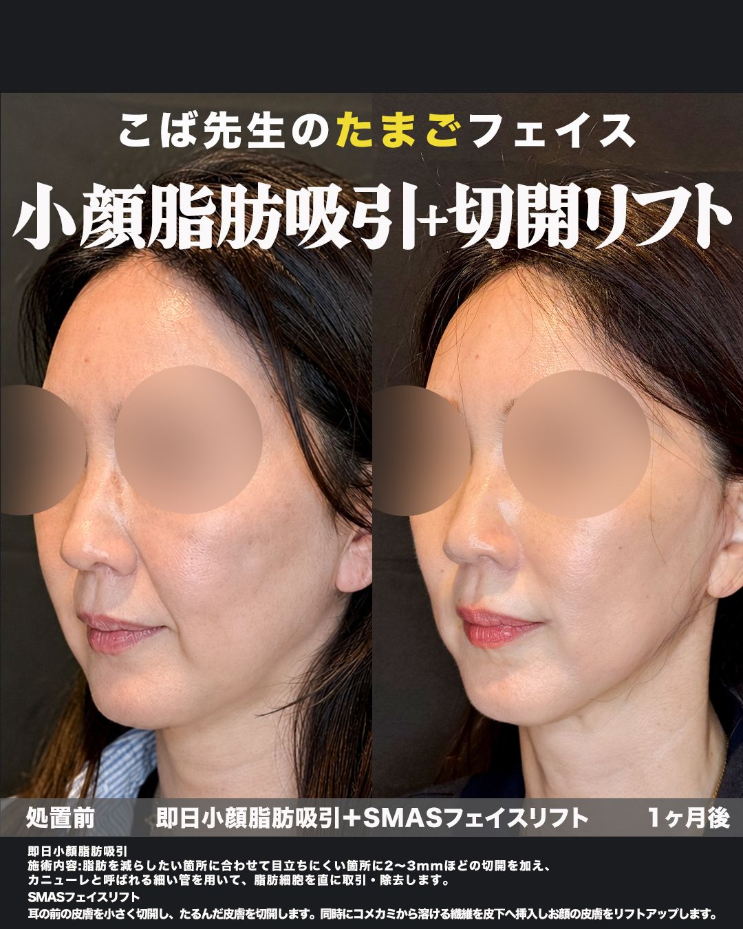 SMASフェイスリフト＋即日小顔脂肪吸引の症例。処置前と術後を斜めから並べた比較写真。