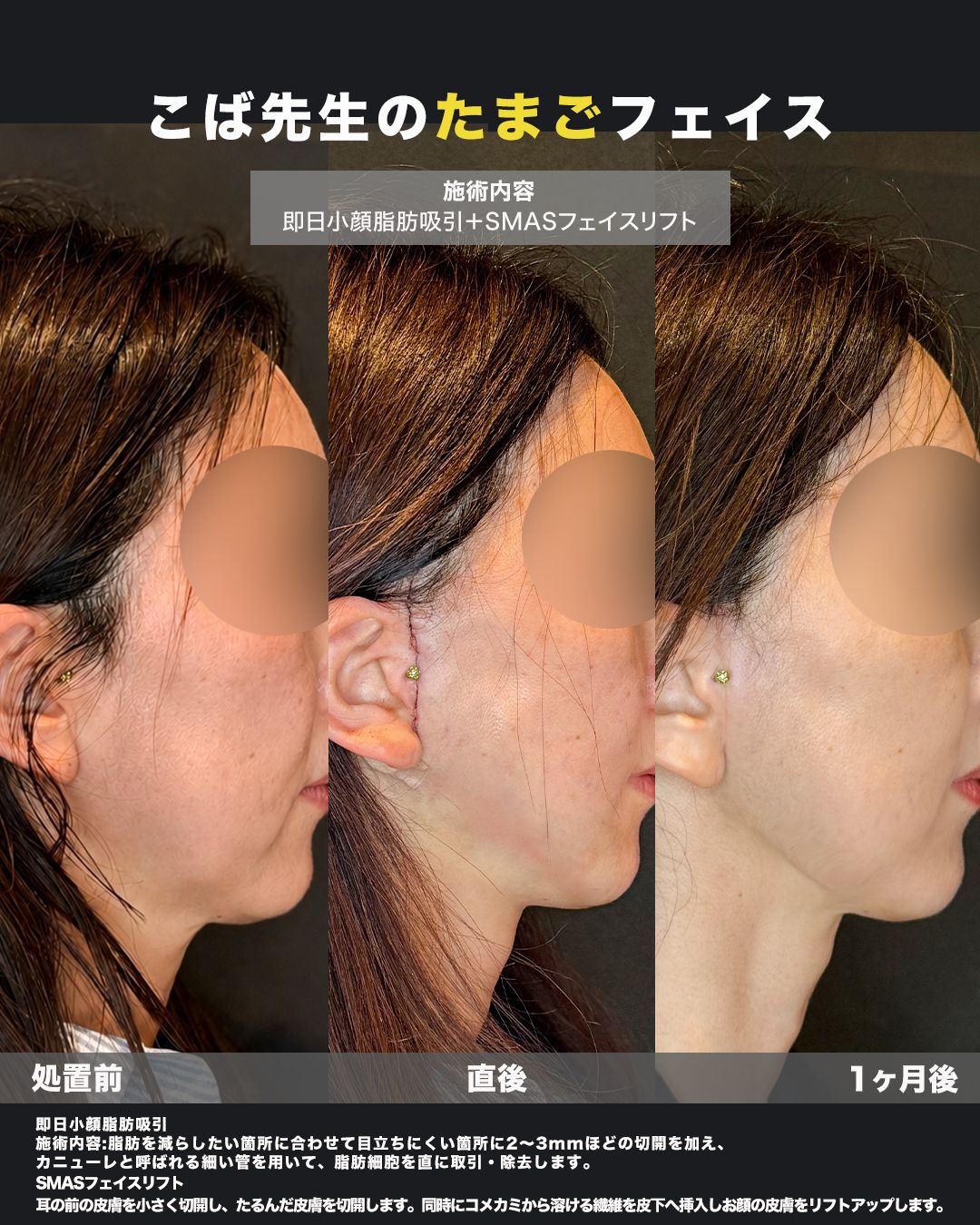 SMASフェイスリフト＋即日小顔脂肪吸引の症例。耳周りの切開部（傷跡）の状態を撮影した写真。