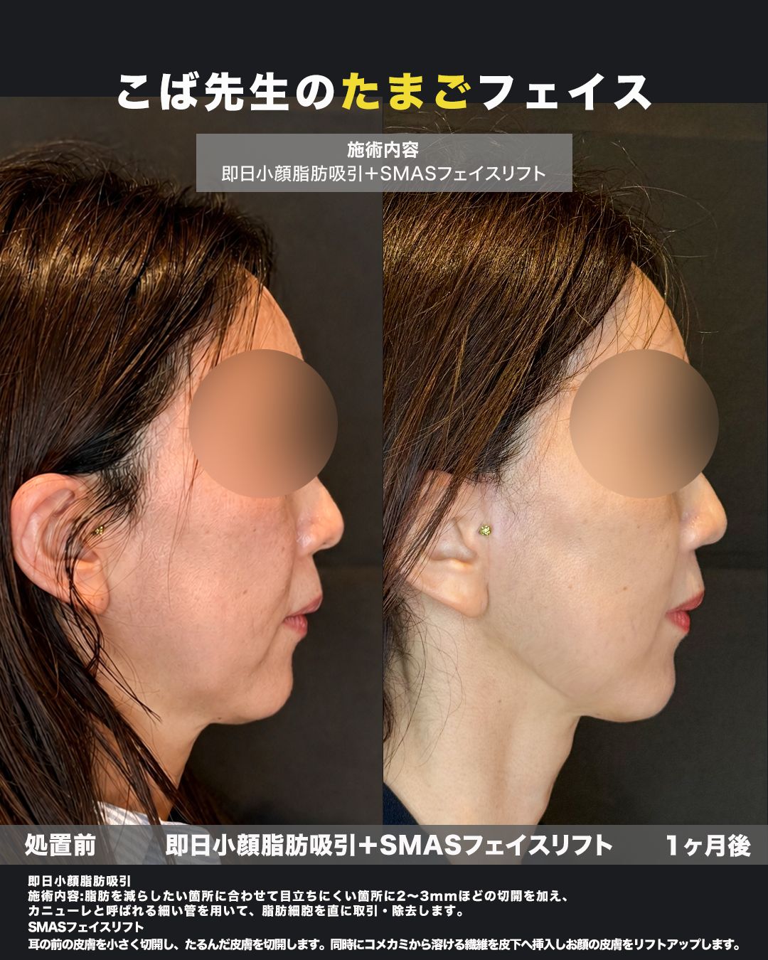 SMASフェイスリフト＋即日小顔脂肪吸引の症例。処置前と術後を横（側面）から並べた比較写真。
