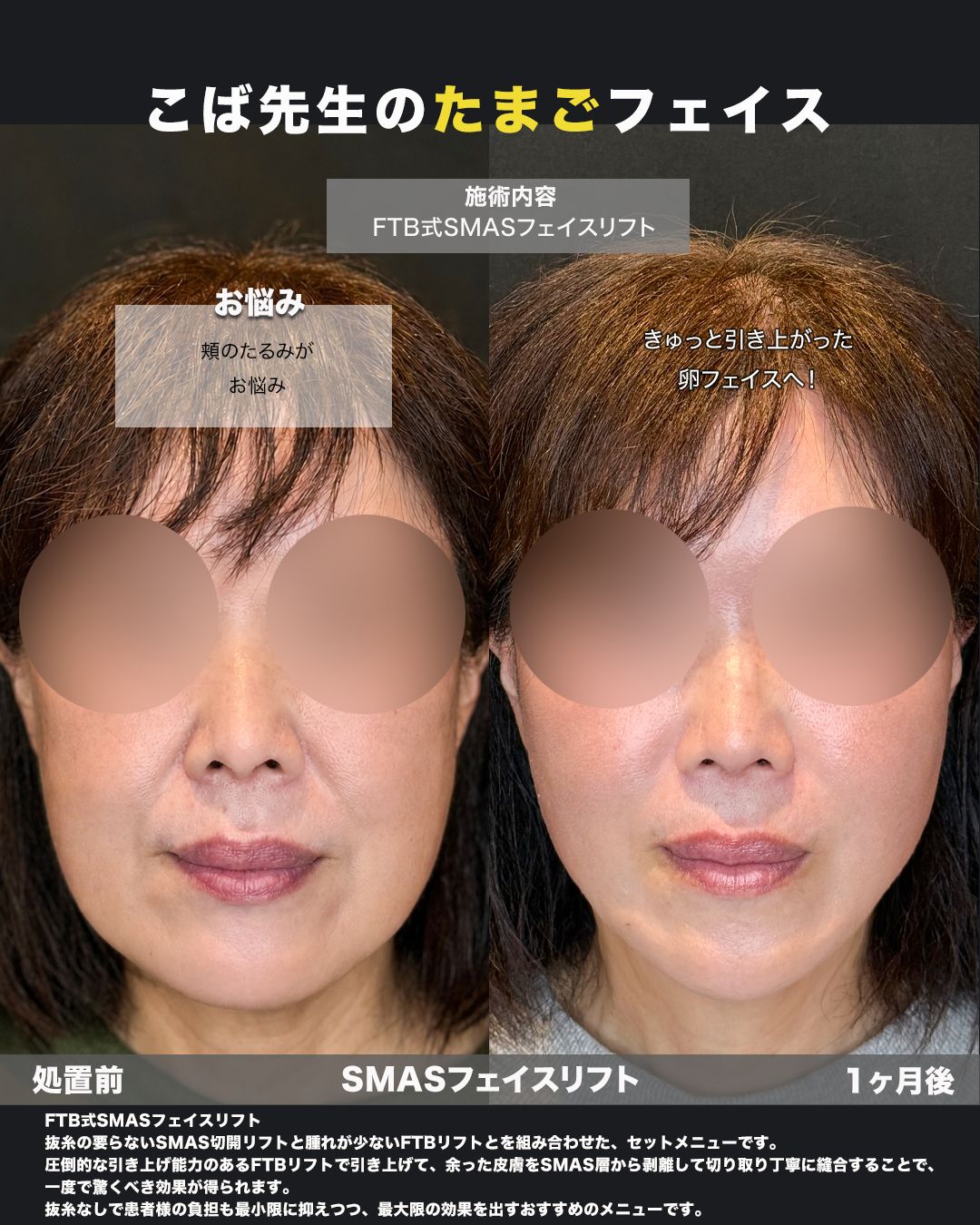 FTB式SMASフェイスリフトの症例。処置前と術後を正面から並べた比較写真。