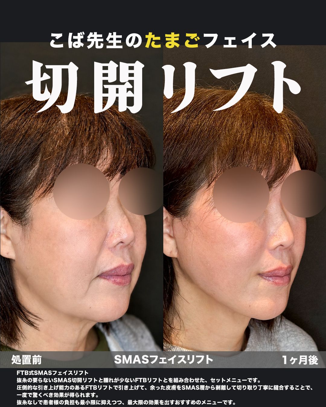 FTB式SMASフェイスリフトの症例。処置前と術後を斜めから並べた比較写真。