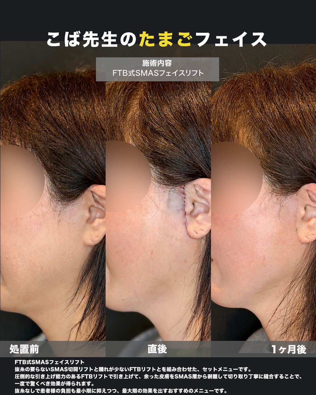 FTB式SMASフェイスリフトの症例。耳周りの切開部（傷跡）の状態を撮影した写真。