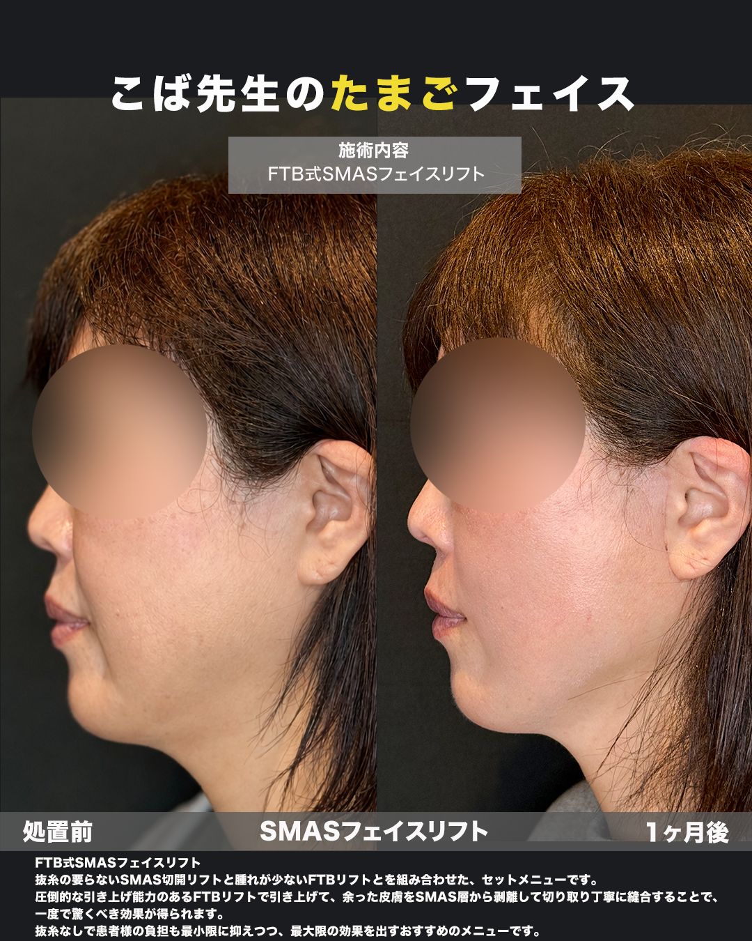 FTB式SMASフェイスリフトの症例。処置前と術後を横（側面）から並べた比較写真。