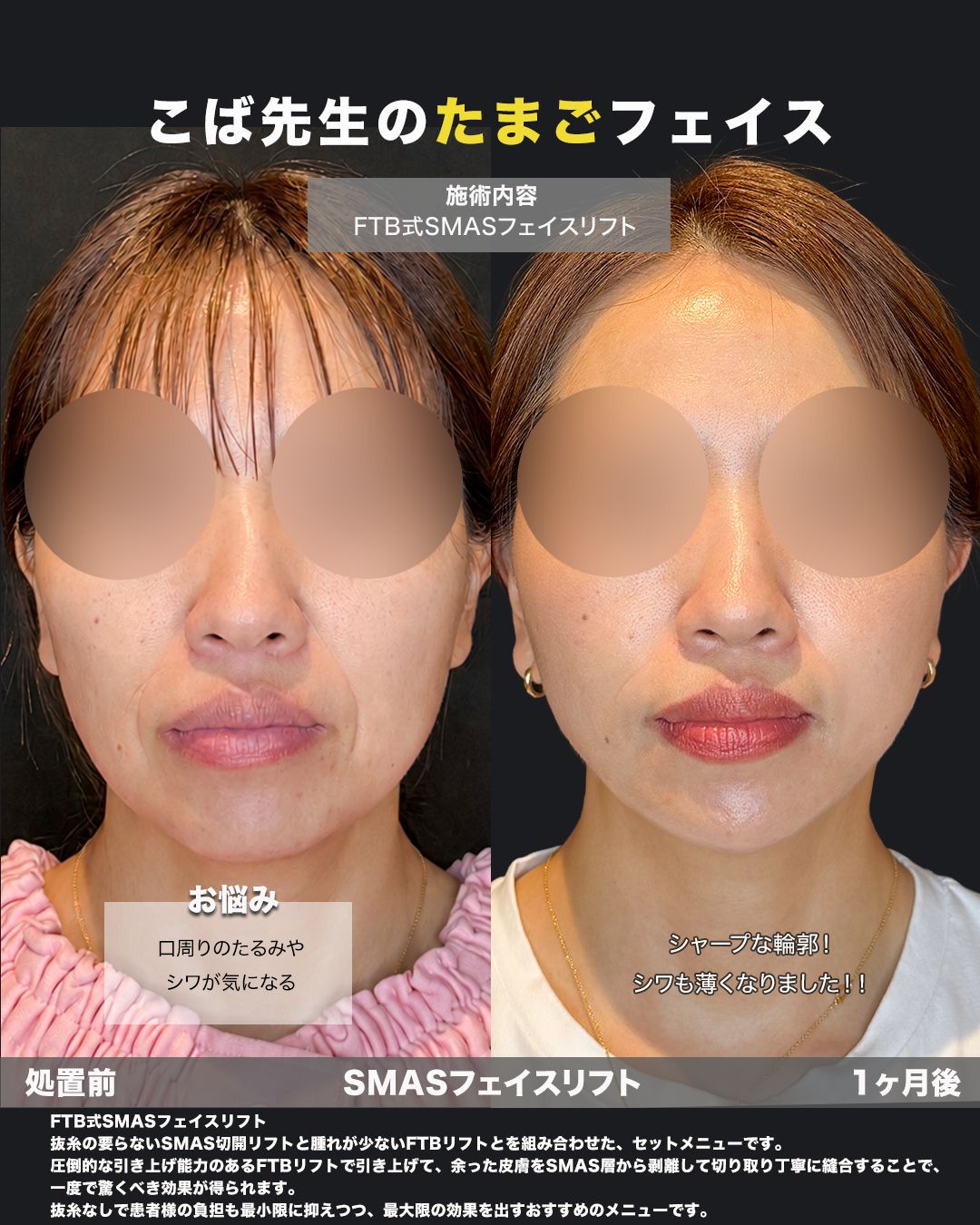 FTB式SMASフェイスリフトの症例。処置前と術後を正面から並べた比較写真。