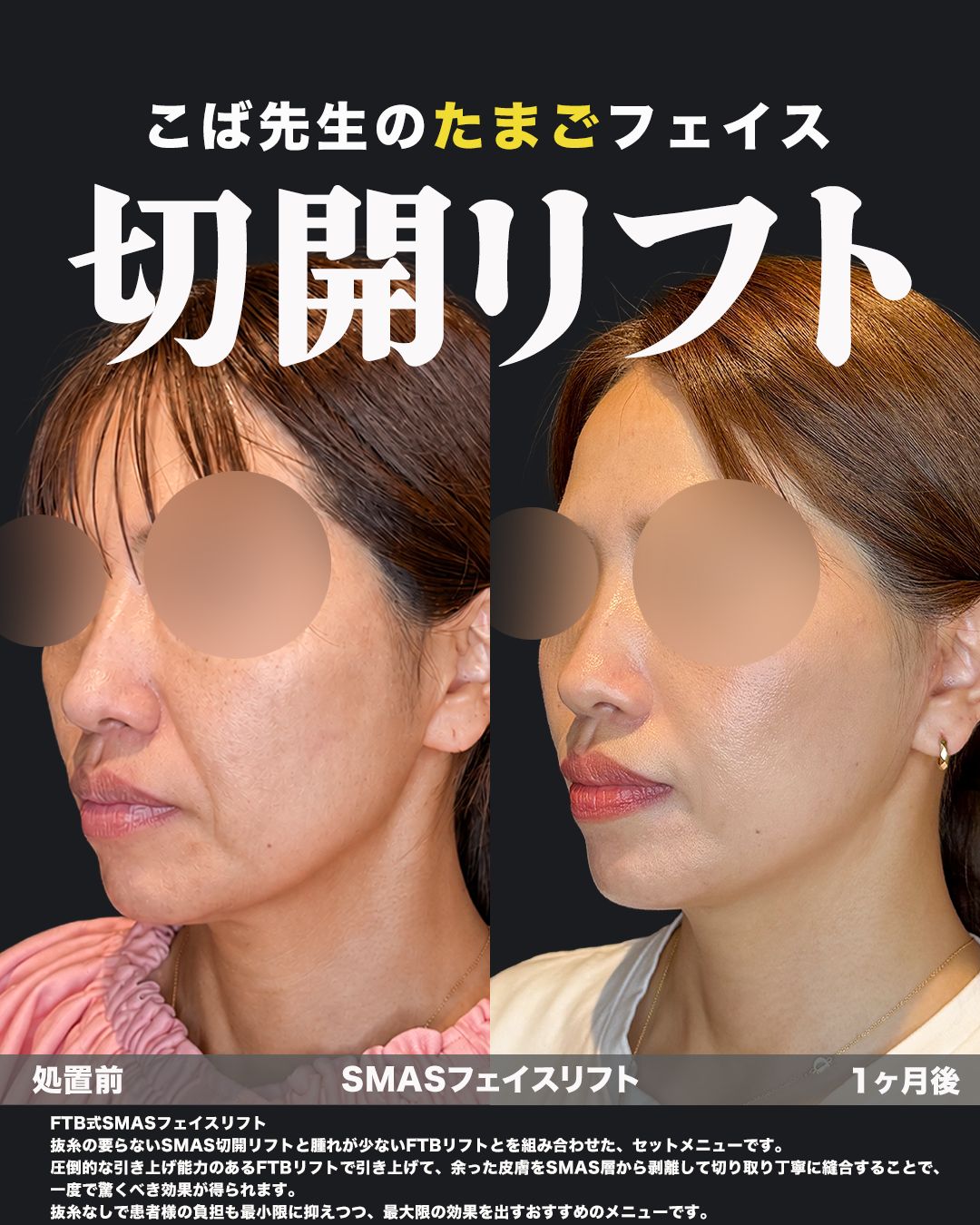 FTB式SMASフェイスリフトの症例。処置前と術後を斜めから並べた比較写真。