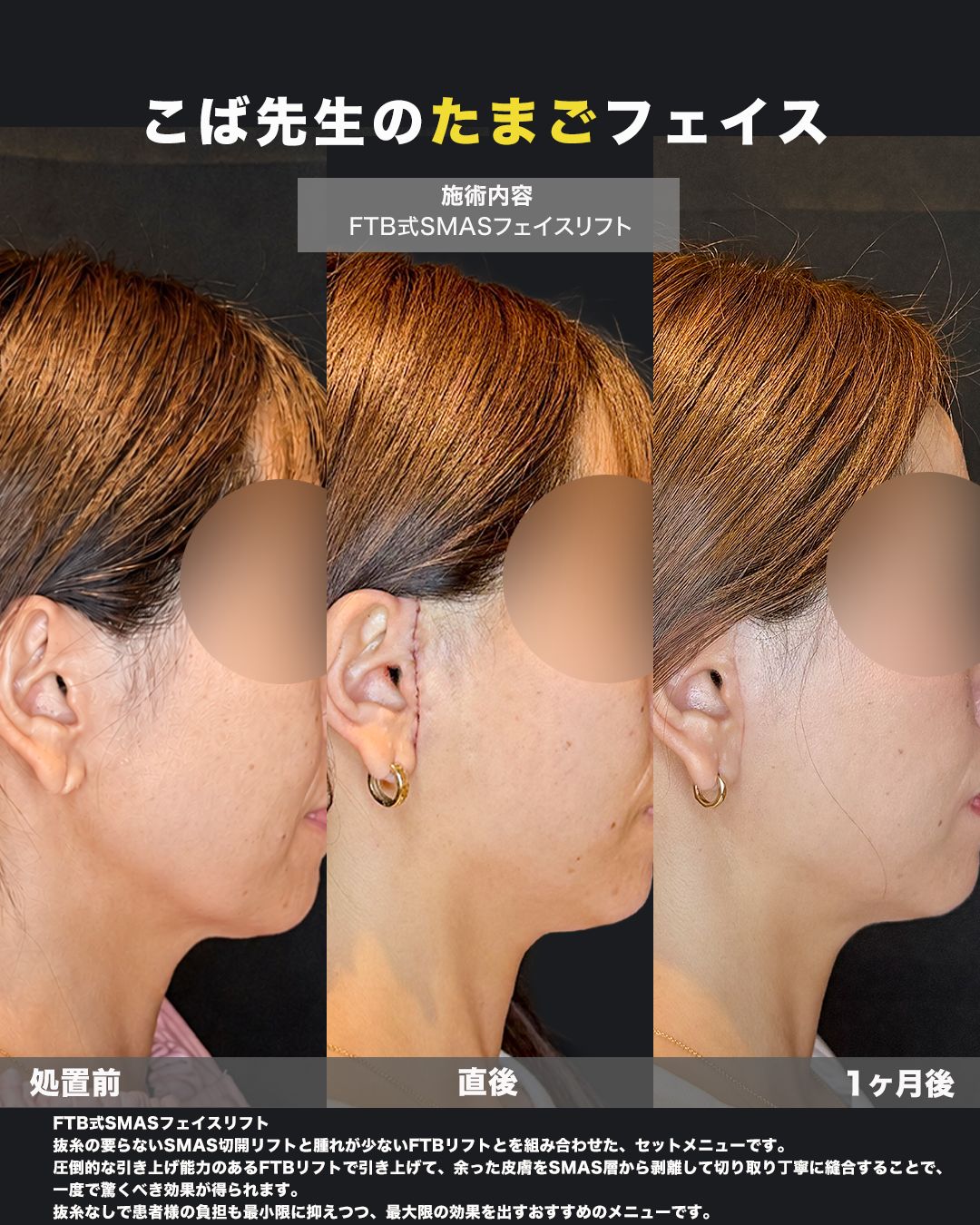 FTB式SMASフェイスリフトの症例。耳周りの切開部（傷跡）の状態を撮影した写真。