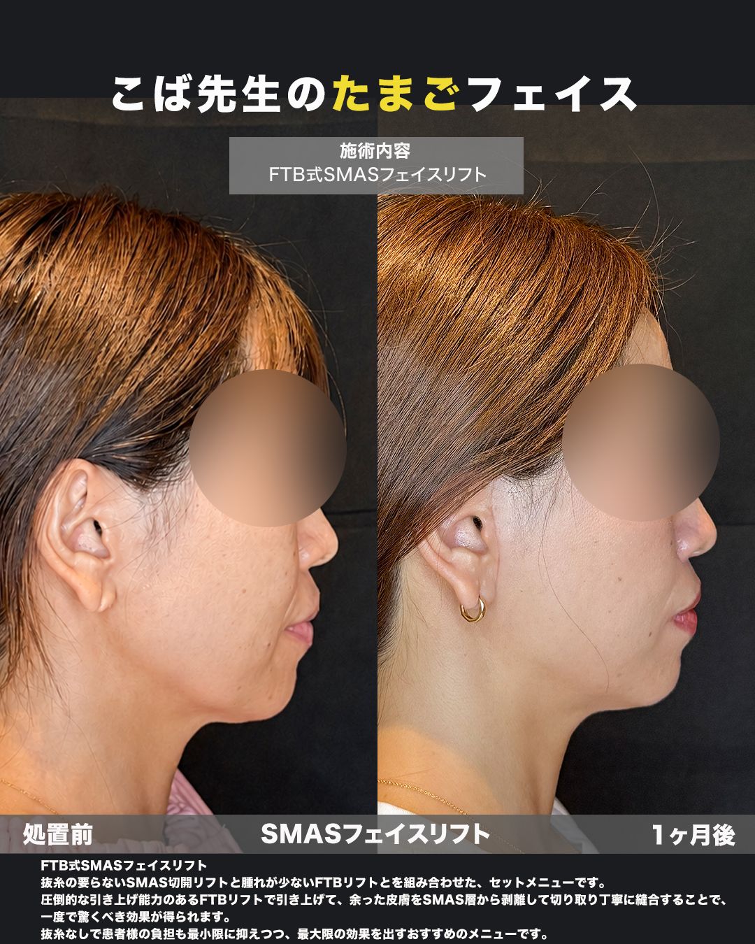 FTB式SMASフェイスリフトの症例。処置前と術後を横（側面）から並べた比較写真。