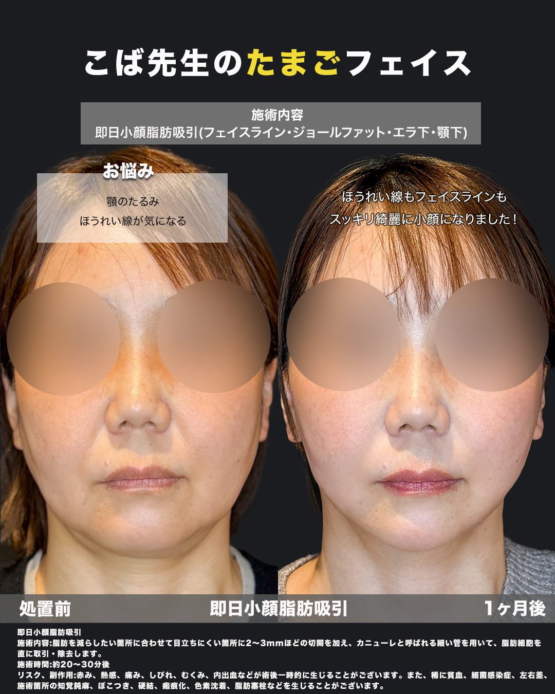 小顔脂肪吸引（フェイスライン・ジョールファット・エラ下・顎下）の症例。処置前と術後を正面から並べた比較写真。