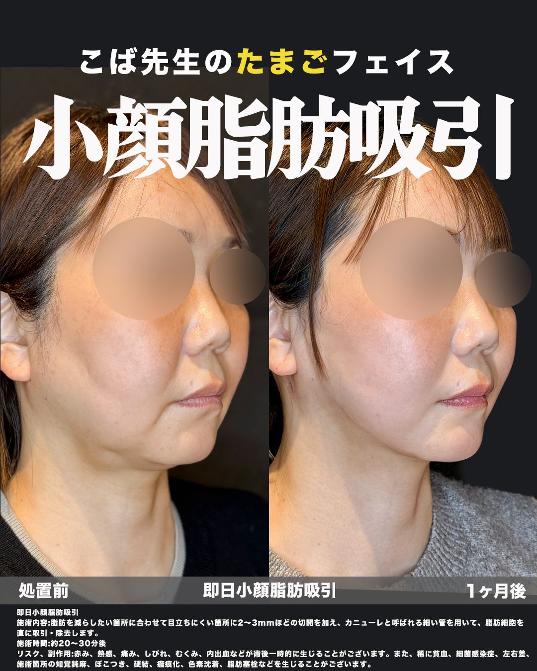 小顔脂肪吸引（フェイスライン・ジョールファット・エラ下・顎下）の症例。処置前と術後を斜めから並べた比較写真。