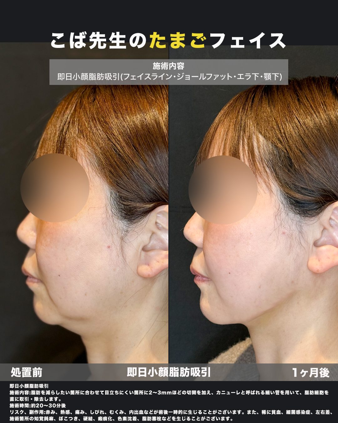 小顔脂肪吸引（フェイスライン・ジョールファット・エラ下・顎下）の症例。処置前と術後を横（側面）から並べた比較写真。