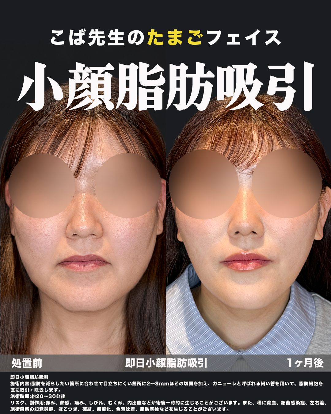 小顔脂肪吸引（エラ下・顎下・フェイスライン・ジョールファット・メーラー・横幅）の症例。処置前と術後を正面から並べた比較写真。
