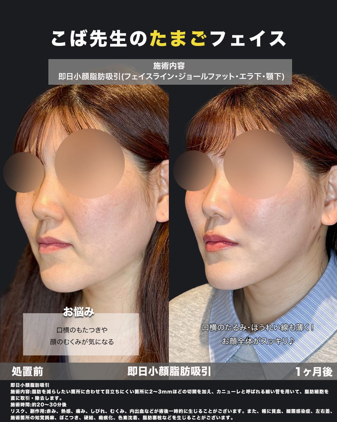 小顔脂肪吸引（エラ下・顎下・フェイスライン・ジョールファット・メーラー・横幅）の症例。処置前と術後を斜めから並べた比較写真。