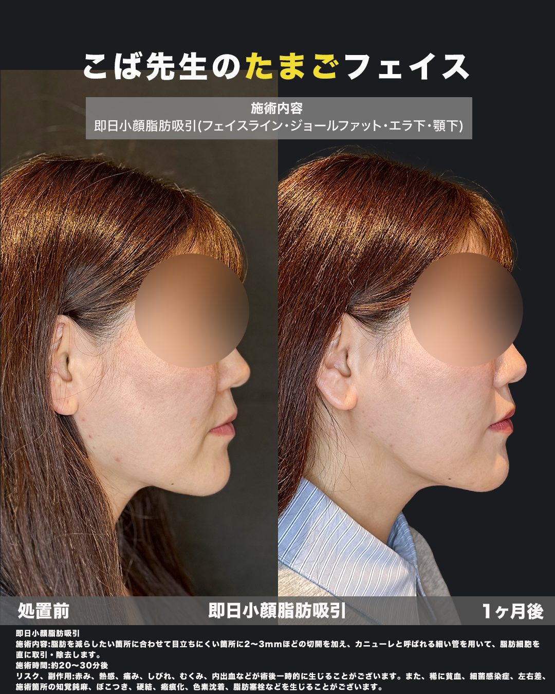 小顔脂肪吸引（エラ下・顎下・フェイスライン・ジョールファット・メーラー・横幅）の症例。処置前と術後を横（側面）から並べた比較写真。