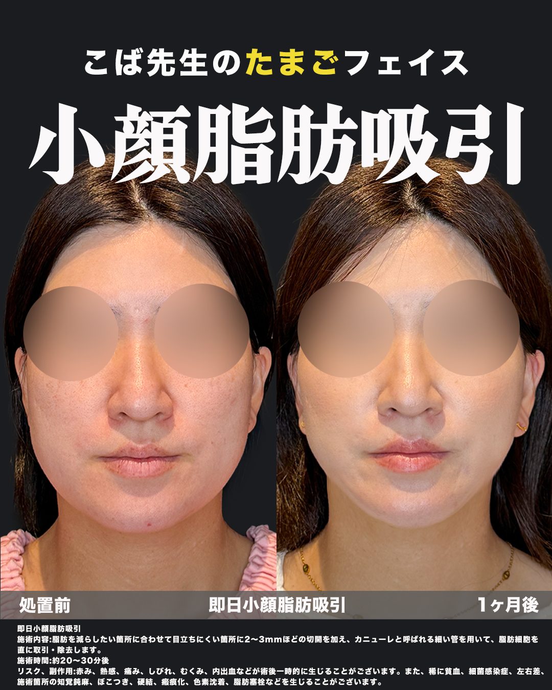小顔脂肪吸引（フェイスライン・ジョールファット）の症例。処置前と術後を正面から並べた比較写真。