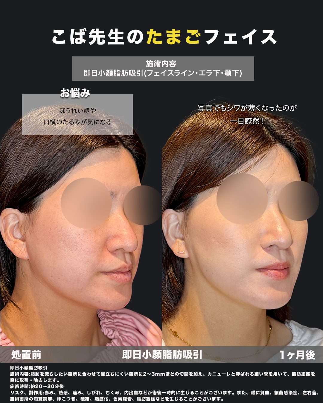 小顔脂肪吸引（フェイスライン・ジョールファット）の症例。処置前と術後を斜めから並べた比較写真。