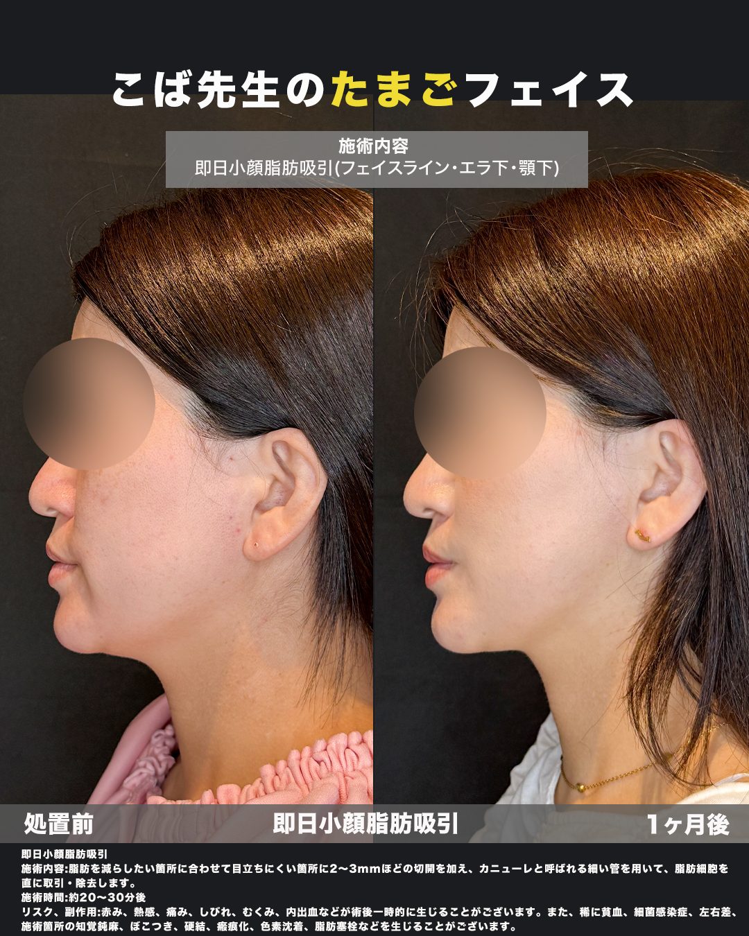 小顔脂肪吸引（フェイスライン・ジョールファット）の症例。処置前と術後を横（側面）から並べた比較写真。