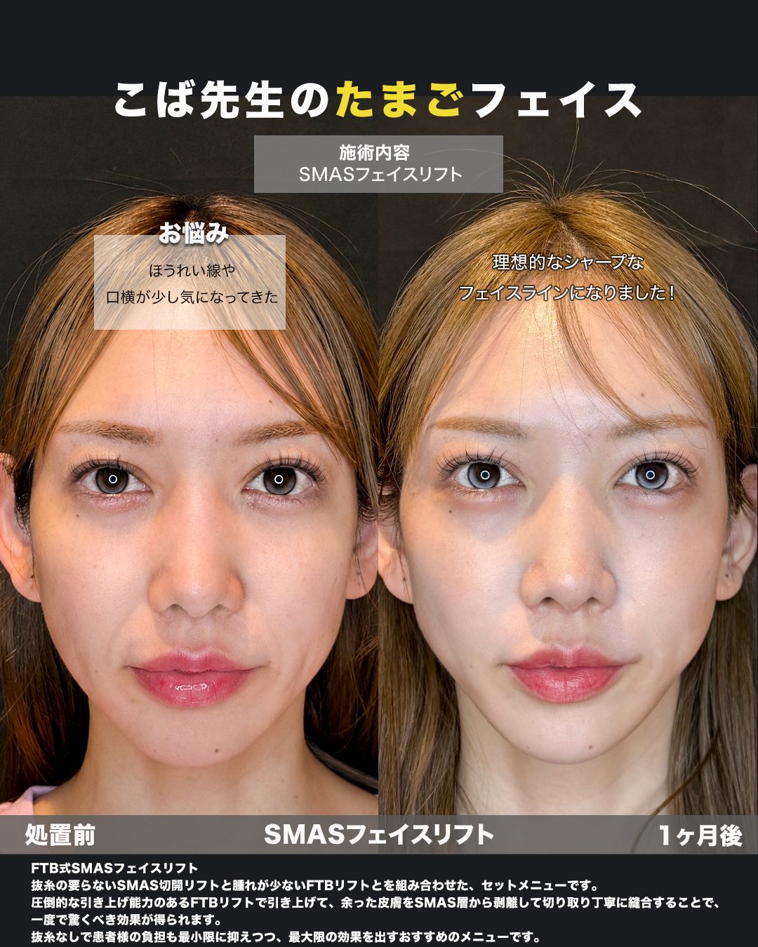 SMASフェイスリフトの症例。処置前と術後を正面から並べた比較写真。