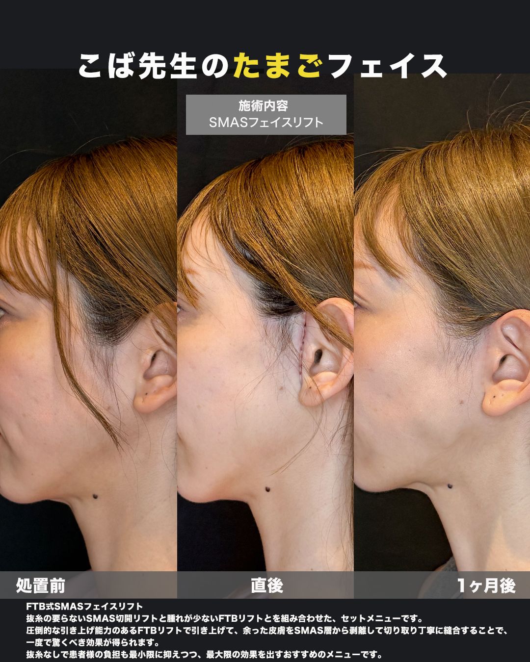 SMASフェイスリフトの症例。耳周りの切開部（傷跡）の状態を撮影した写真。