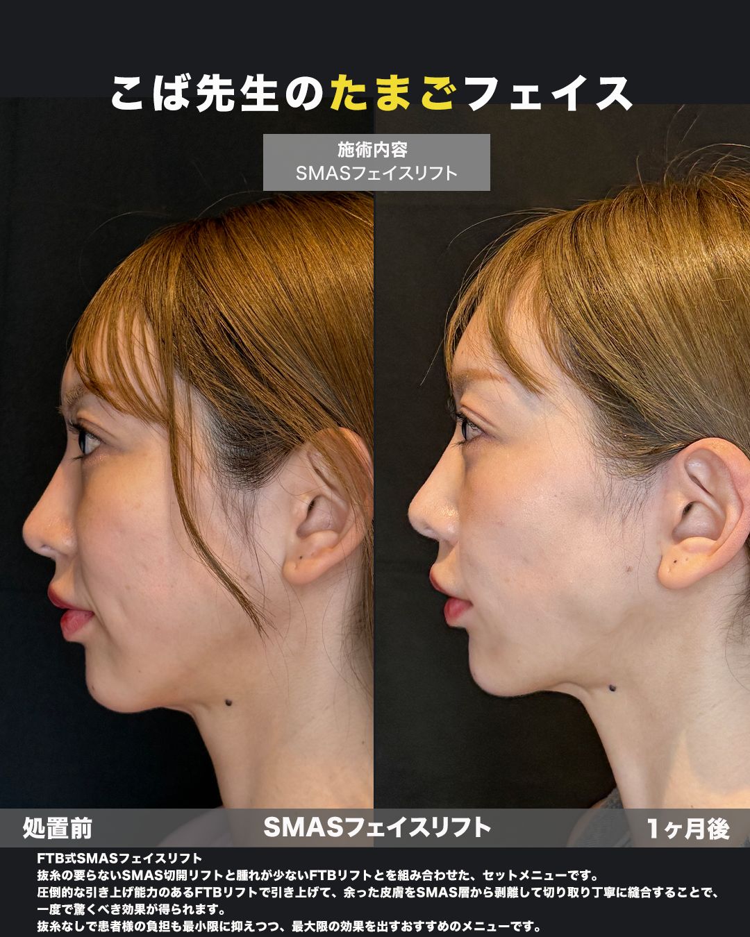 SMASフェイスリフトの症例。処置前と術後を横（側面）から並べた比較写真。