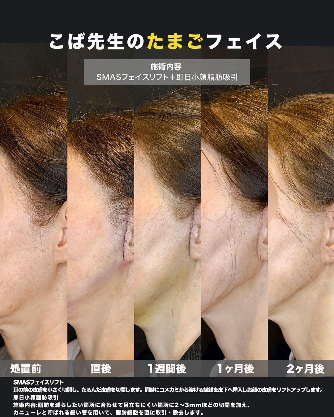 SMASフェイスリフト＋即日小顔脂肪吸引の症例。処置前から術後までの経過を並べた比較写真。