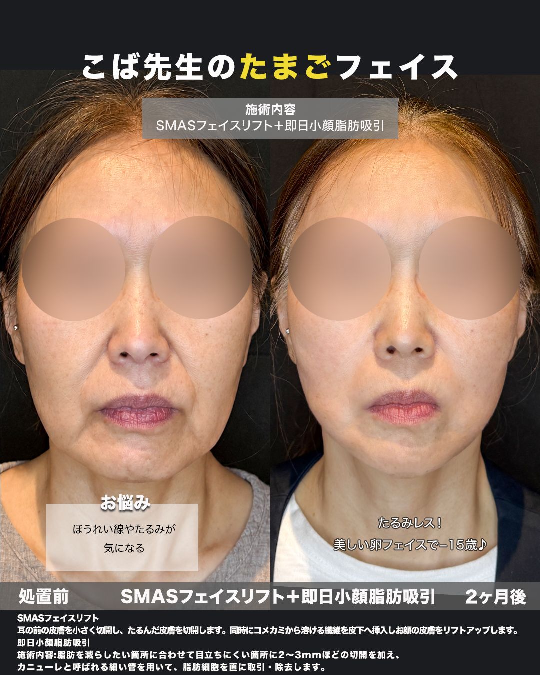 SMASフェイスリフト＋即日小顔脂肪吸引の症例。処置前と術後を正面から並べた比較写真。
