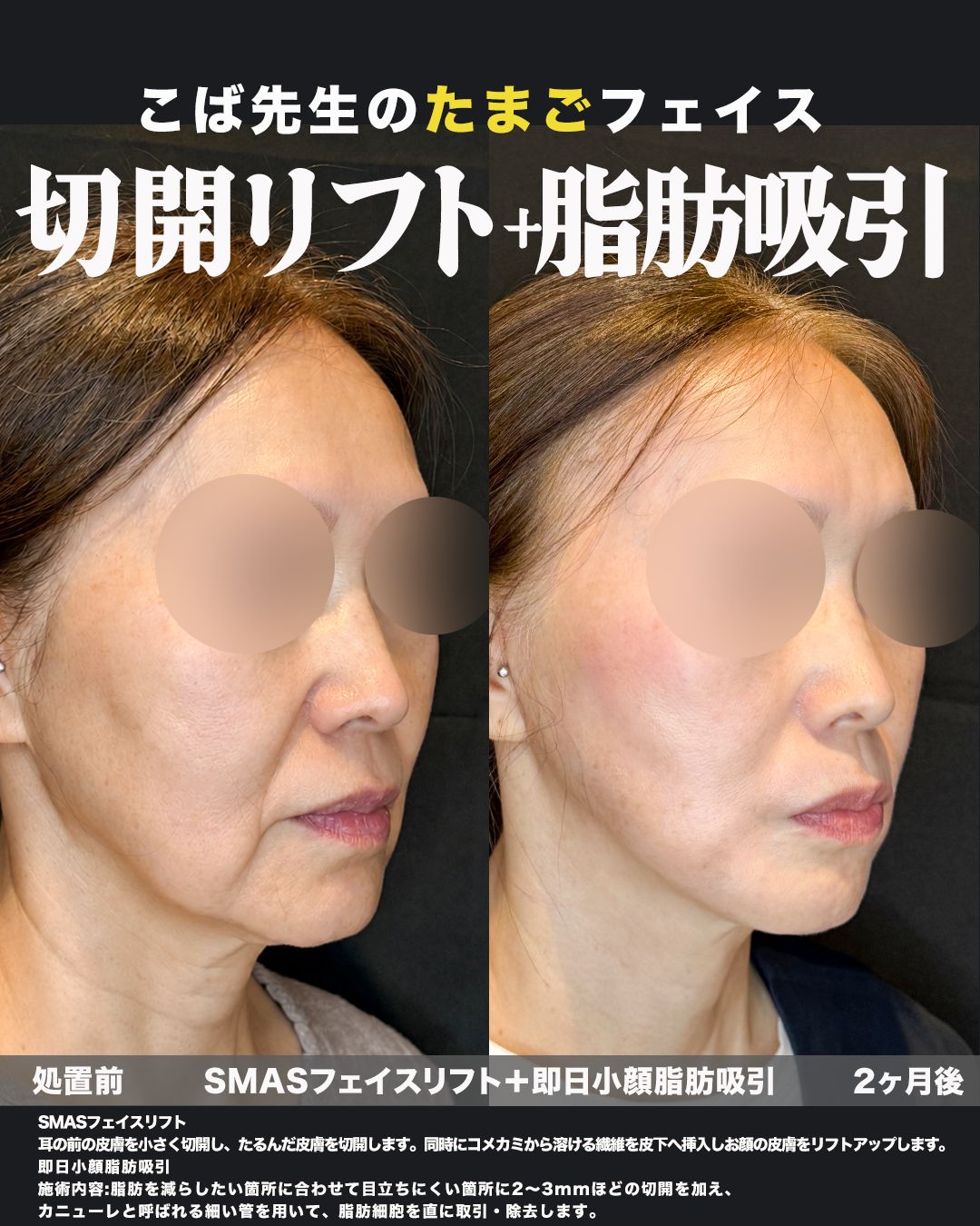 SMASフェイスリフト＋即日小顔脂肪吸引の症例。処置前と術後を斜めから並べた比較写真。