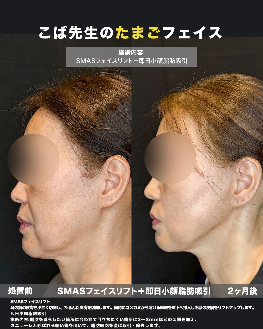SMASフェイスリフト＋即日小顔脂肪吸引の症例。処置前と術後を横（側面）から並べた比較写真。