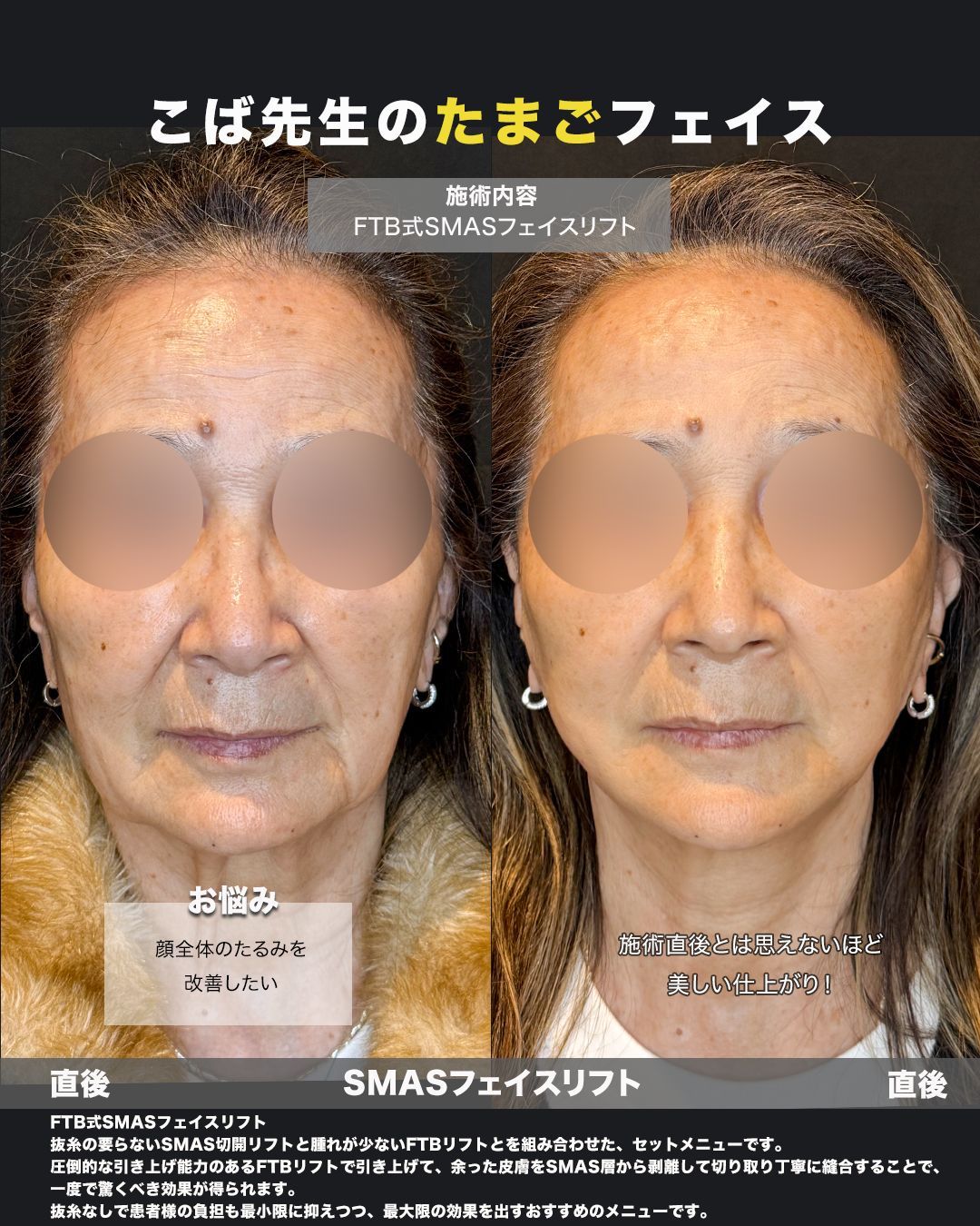 FTB式SMASフェイスリフトの症例。処置前と術後を正面から並べた比較写真。