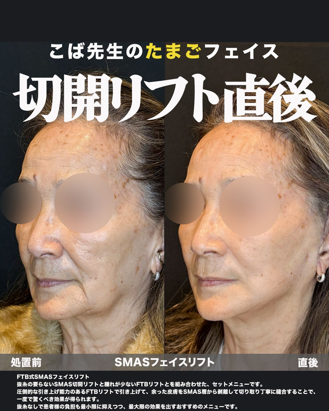 FTB式SMASフェイスリフトの症例。処置前と術後を斜めから並べた比較写真。