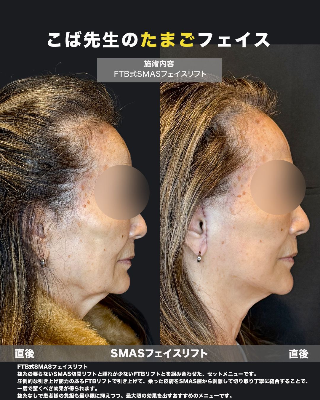 FTB式SMASフェイスリフトの症例。処置前と術後を横（側面）から並べた比較写真。