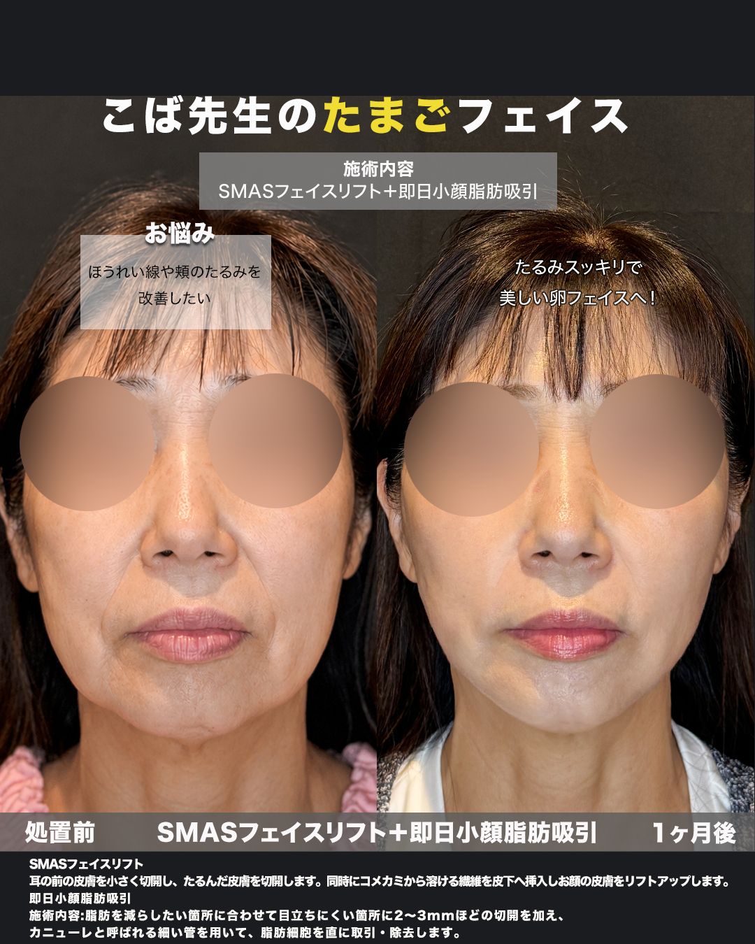 SMASフェイスリフト＋即日小顔脂肪吸引の症例。処置前と術後を正面から並べた比較写真。