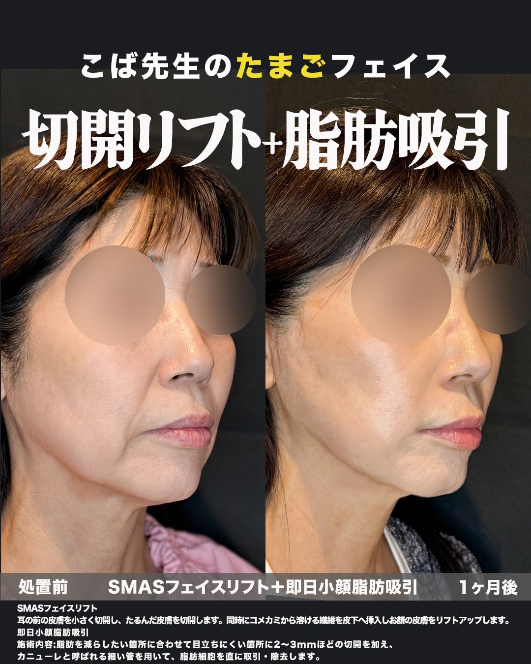 SMASフェイスリフト＋即日小顔脂肪吸引の症例。処置前と術後を斜めから並べた比較写真。