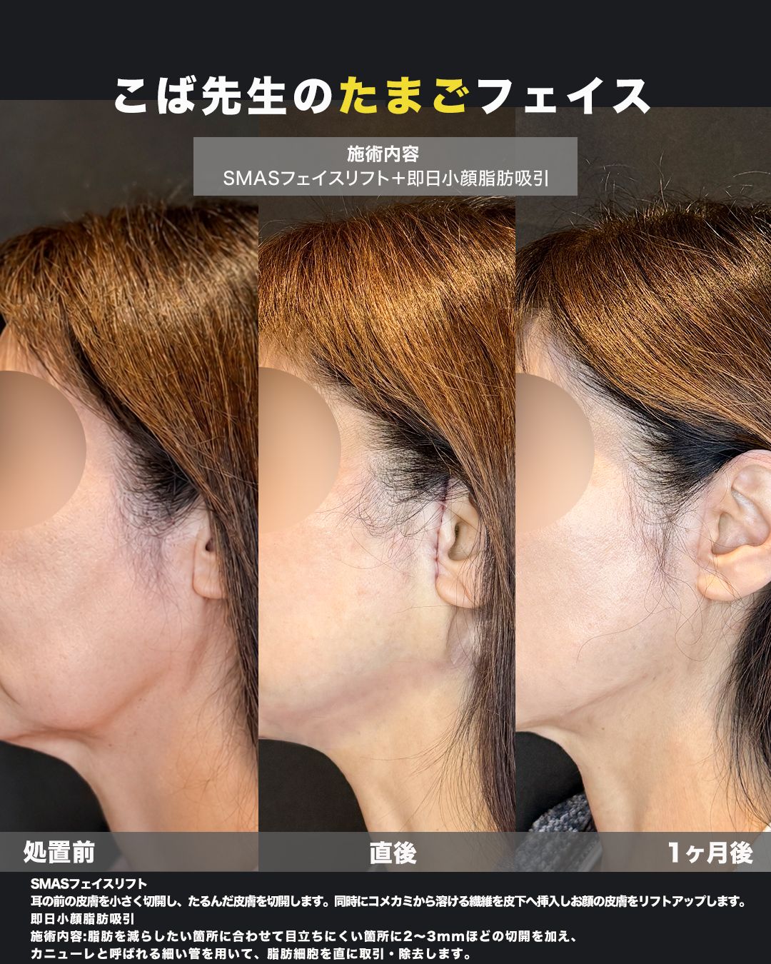 SMASフェイスリフト＋即日小顔脂肪吸引の症例。耳周りの切開部（傷跡）の状態を撮影した写真。