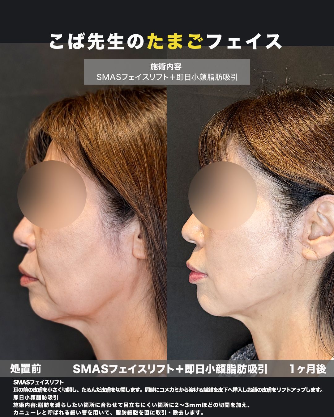 SMASフェイスリフト＋即日小顔脂肪吸引の症例。処置前と術後を横（側面）から並べた比較写真。