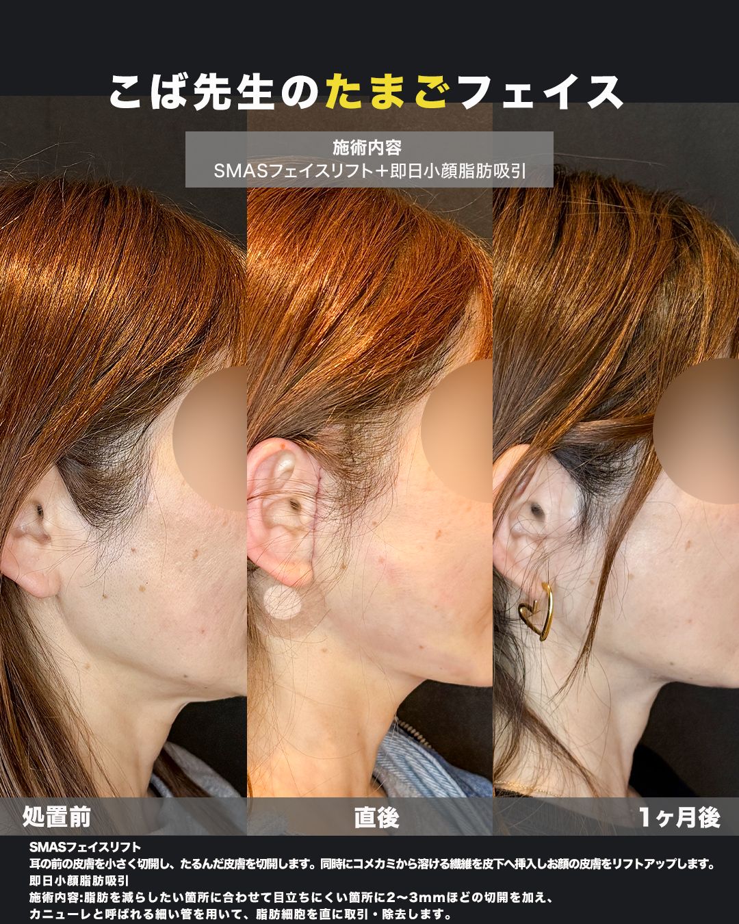 SMASフェイスリフト＋脂肪吸引の症例。処置前から術後までの経過を並べた比較写真。