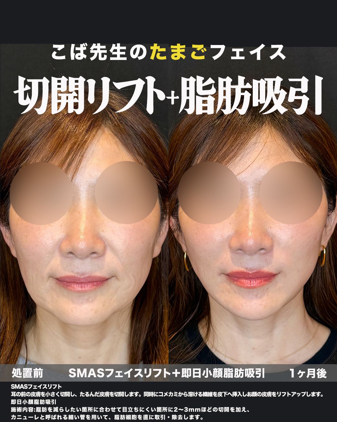 SMASフェイスリフト＋脂肪吸引の症例。処置前と術後を正面から並べた比較写真。