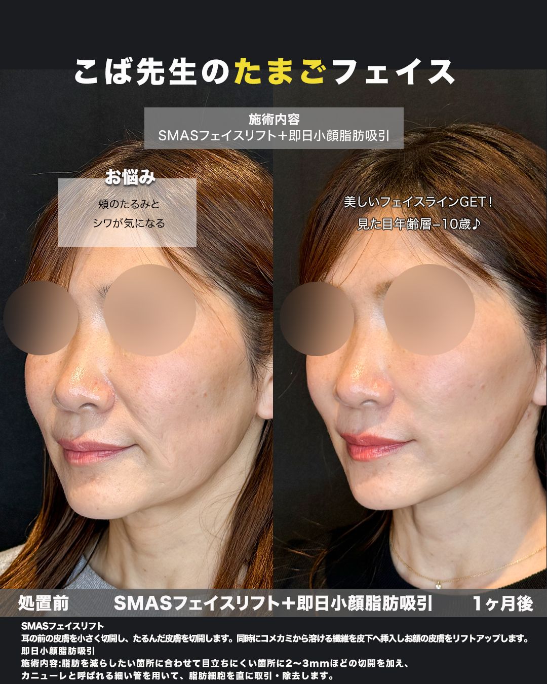 SMASフェイスリフト＋脂肪吸引の症例。処置前と術後を斜めから並べた比較写真。