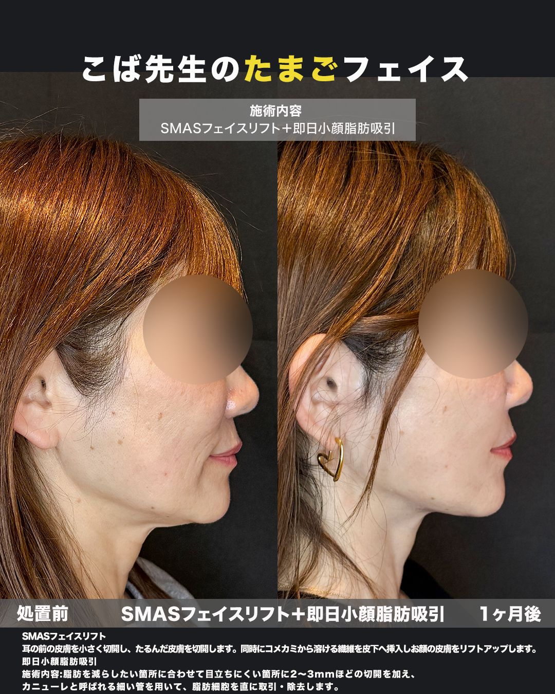 SMASフェイスリフト＋脂肪吸引の症例。処置前と術後を横（側面）から並べた比較写真。