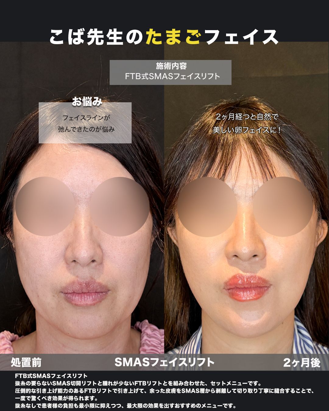 FTB式SMASフェイスリフトの症例。処置前と術後を正面から並べた比較写真。