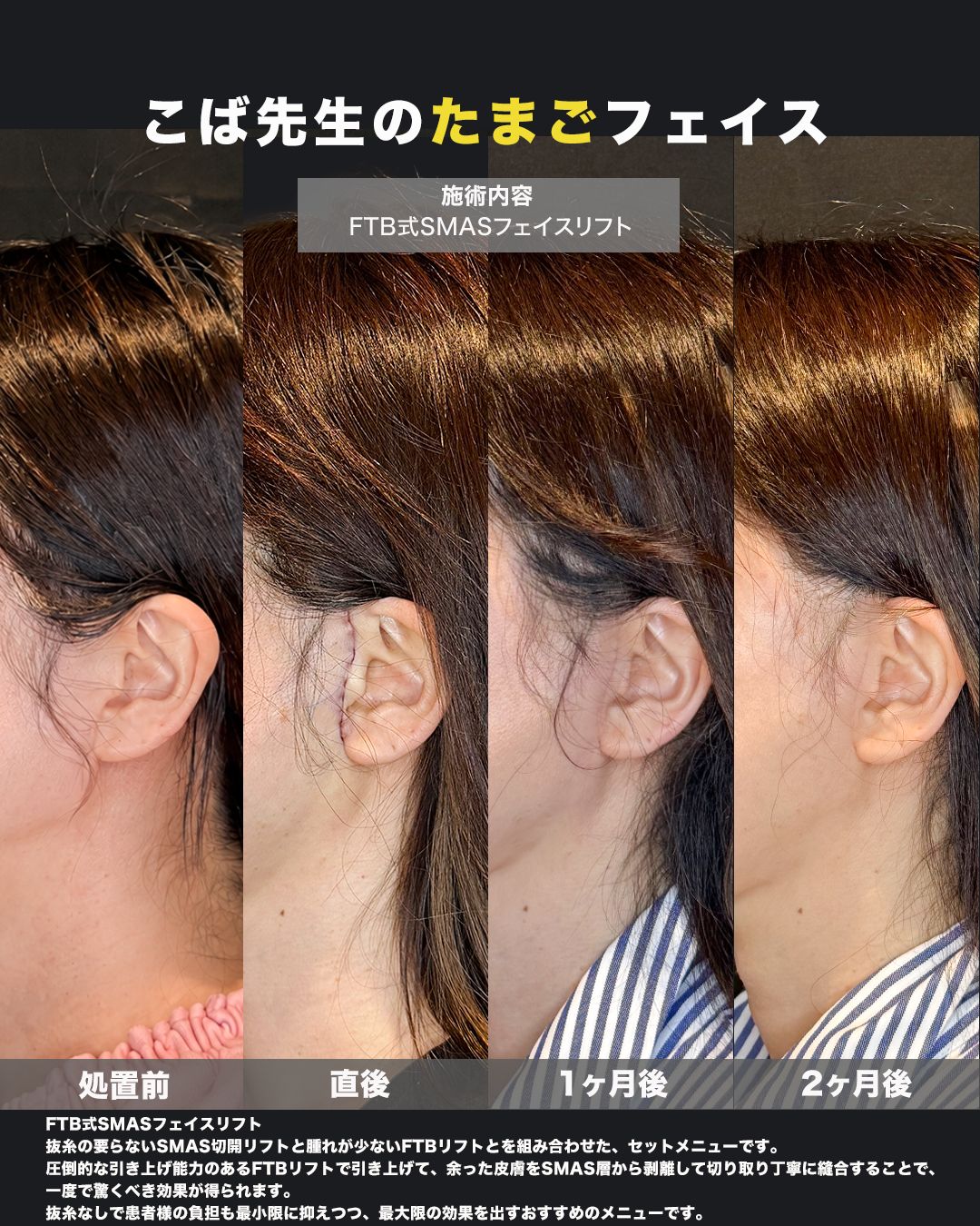 FTB式SMASフェイスリフトの症例。処置前と術後を横（側面）から並べた比較写真。