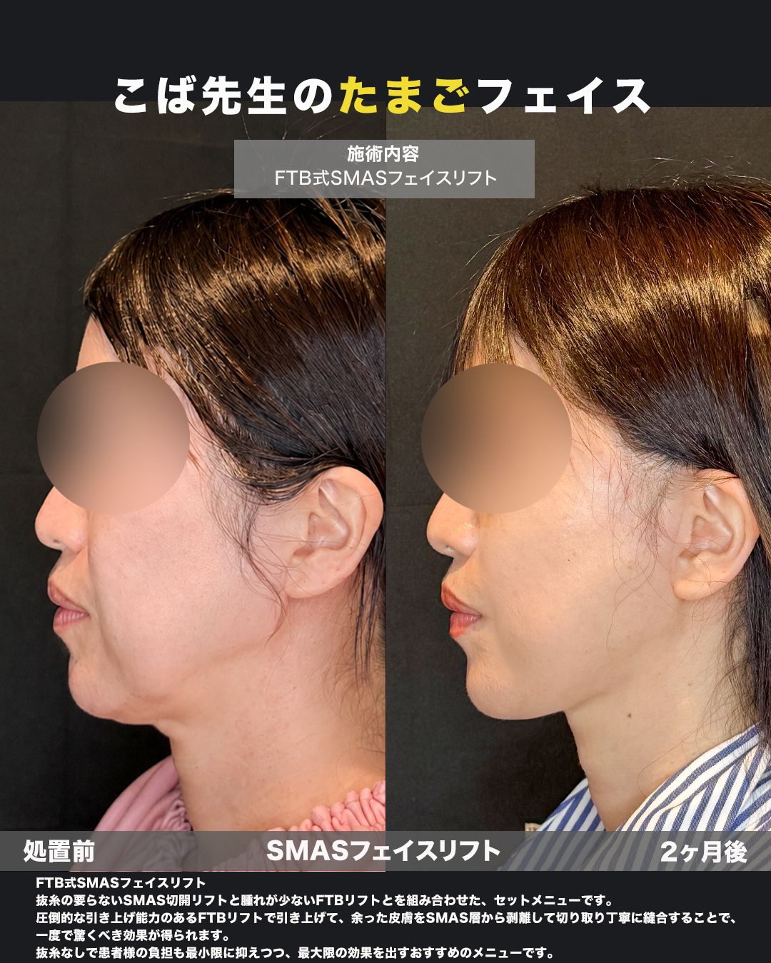 FTB式SMASフェイスリフトの症例。耳周りの切開部（傷跡）の状態を撮影した写真。
