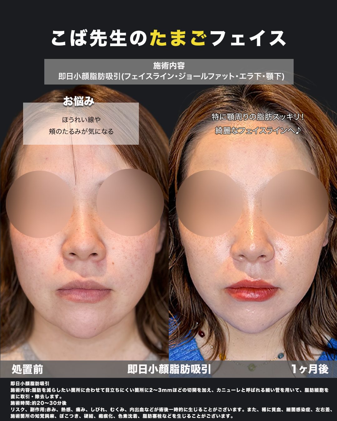 小顔脂肪吸引（フェイスライン・ジョールファット・エラ下・顎下）の症例。処置前と術後を正面から並べた比較写真。