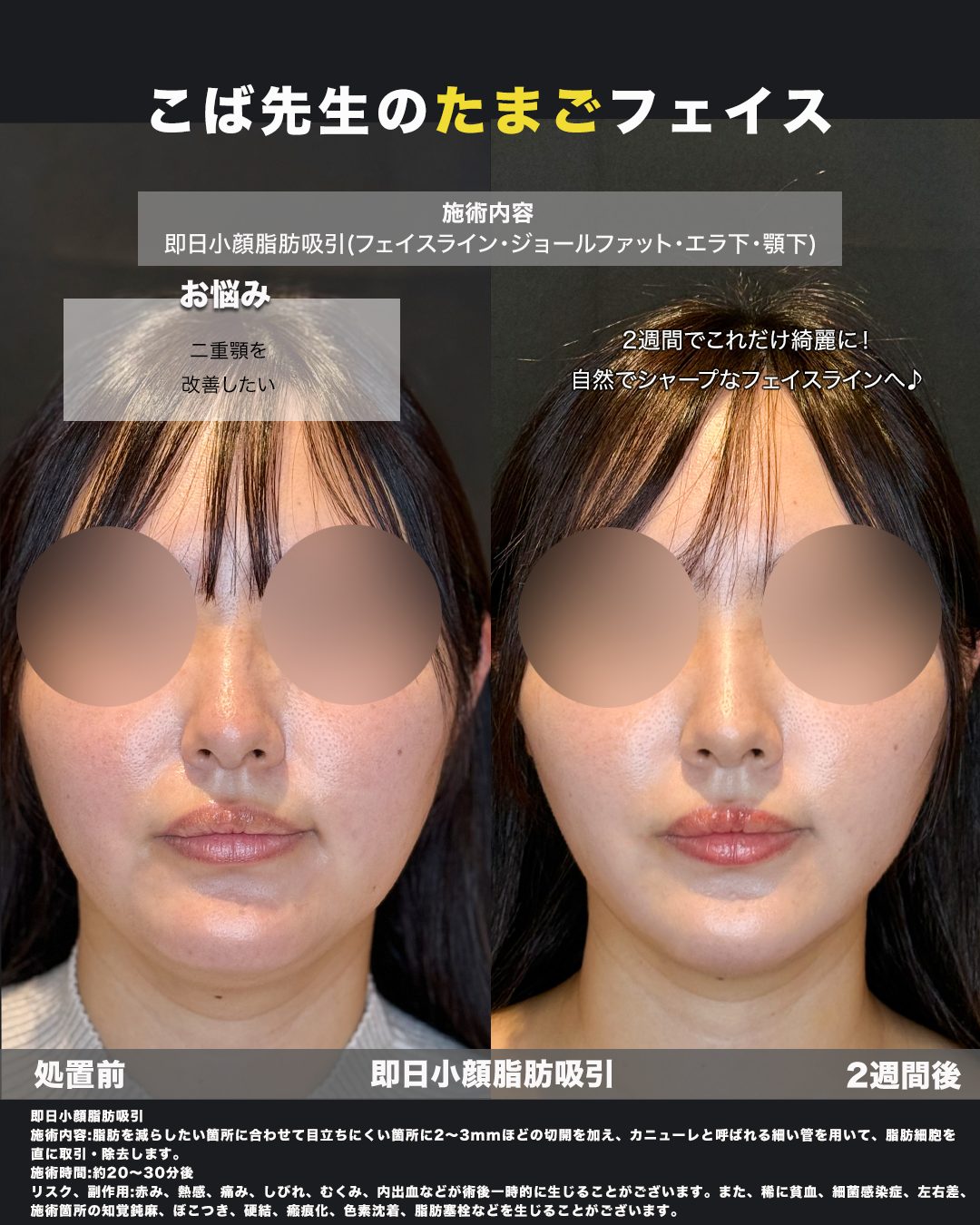 小顔脂肪吸引（フェイスライン・ジョールファット・エラ下・顎下）の症例。処置前と術後を正面から並べた比較写真。